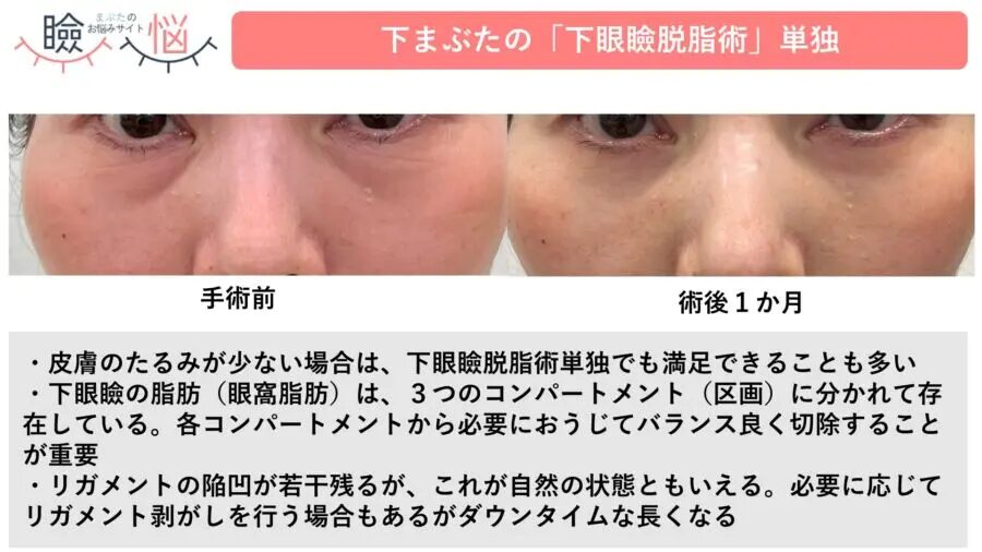 下眼瞼脱脂(経結膜脱脂)