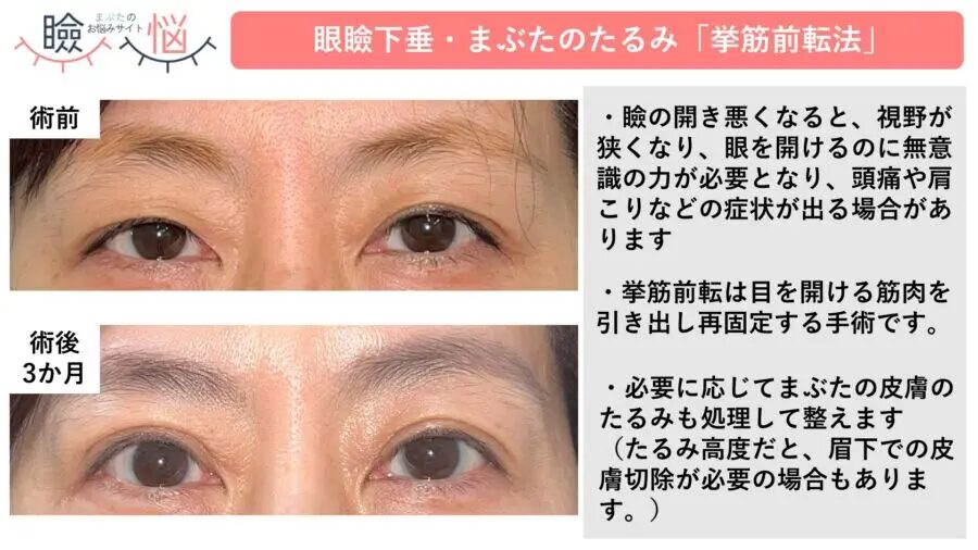 眼瞼下垂手術（挙筋前転法）
