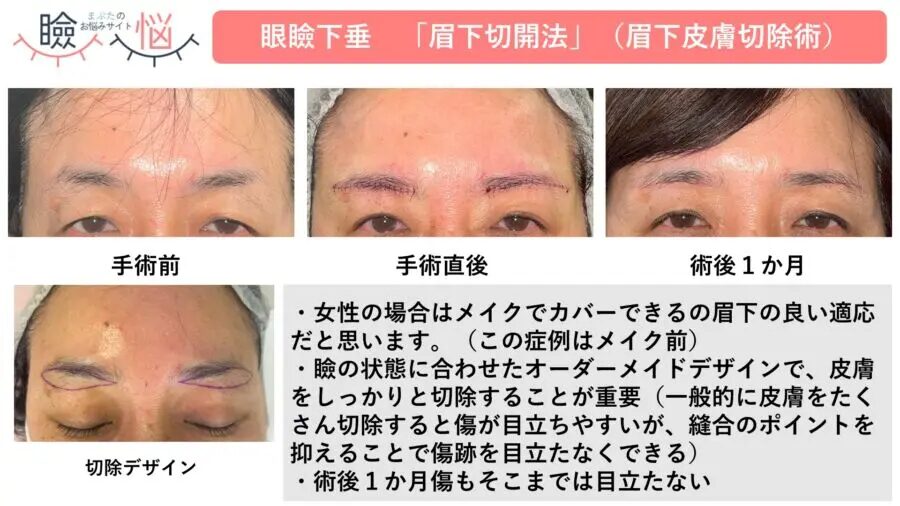 眉下切開（眉下皮膚切除）