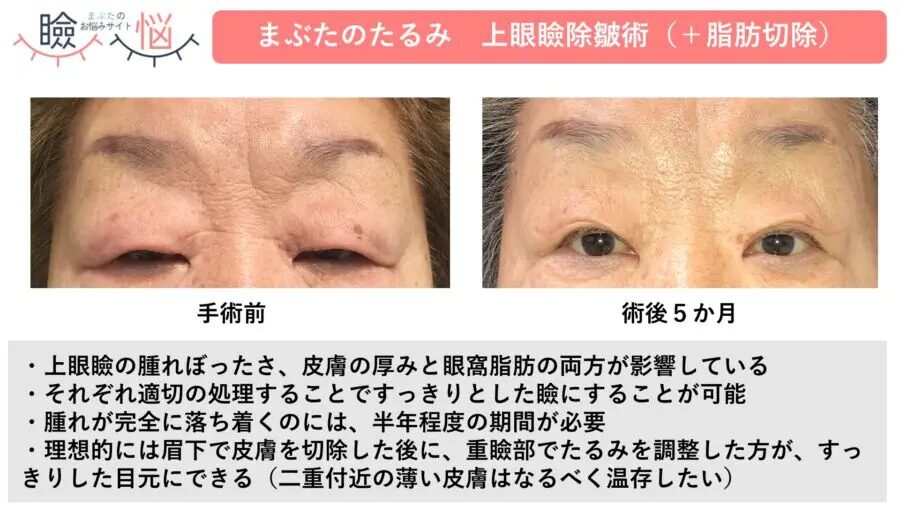 上眼瞼切開術（じょうがんけんせっかいじゅつ）
