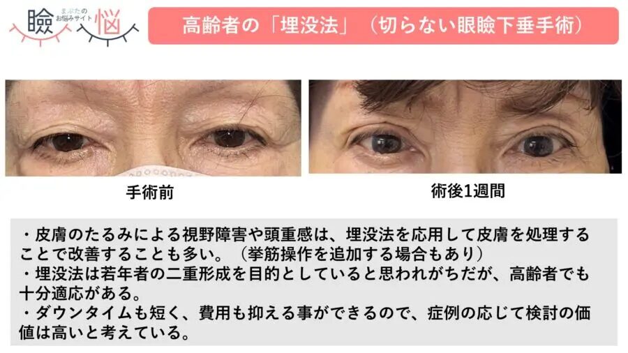 眼瞼下垂治療（埋没法）