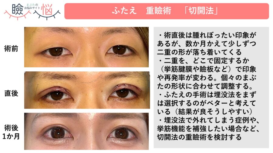 切開法