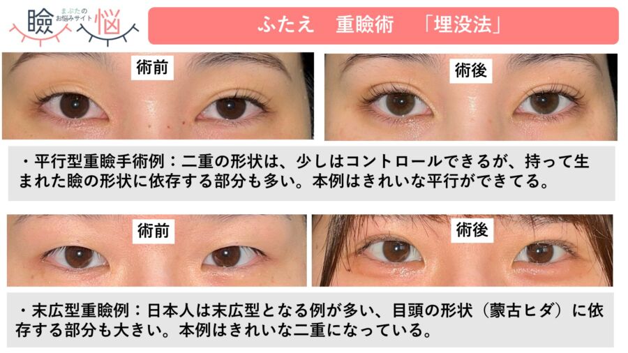埋没法（切らない二重整形）