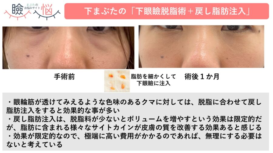 治療例:経結膜脱脂+脂肪注入(戻し脂肪注入)