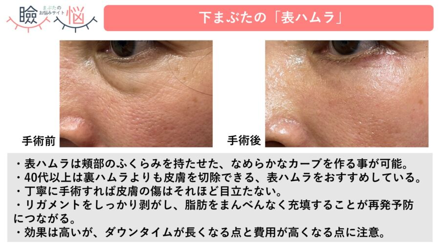 治療例:ハムラ法(脂肪移動術)