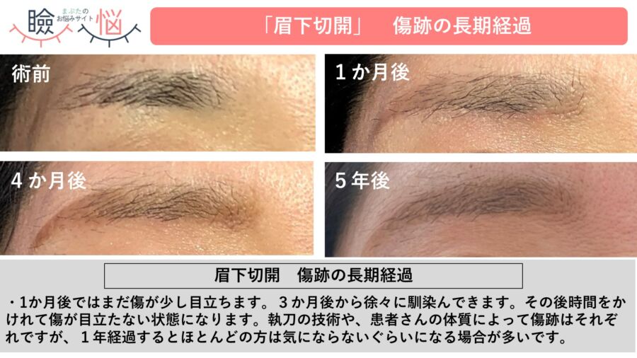 症例写真2:眉下切開法