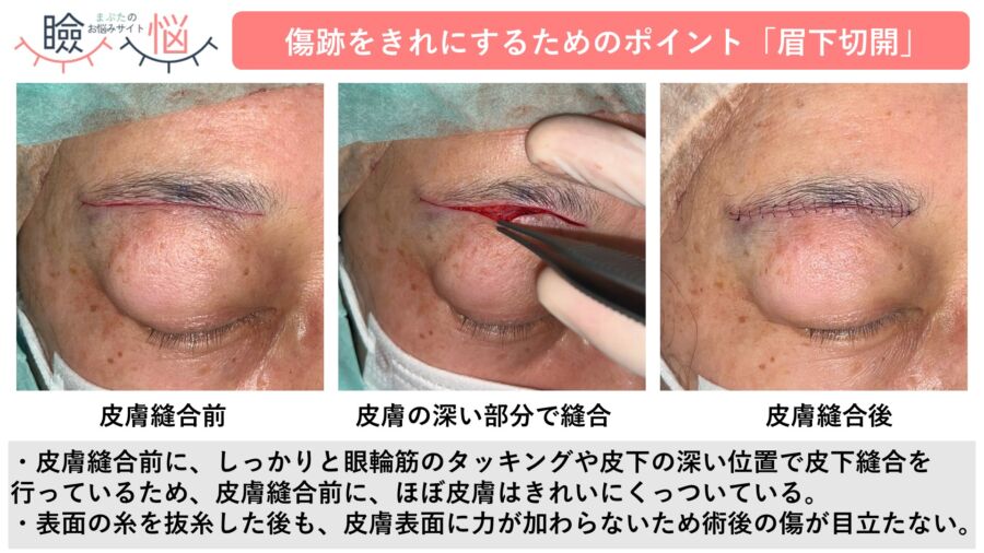 症例写真3:眉下切開法