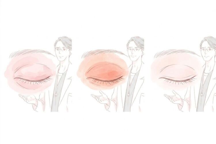 切開法後の腫れが日ごとに引いていく経過のイラスト